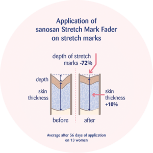 treatment of stretch marks