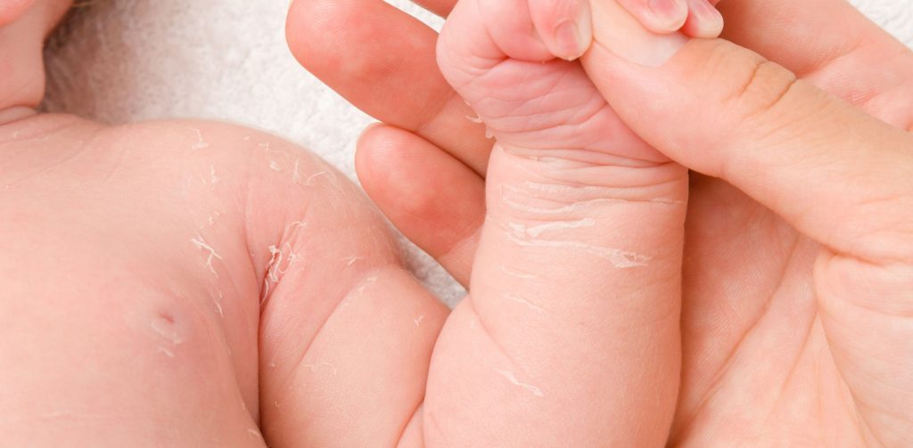 Baby mit trockener und schuppender Haut