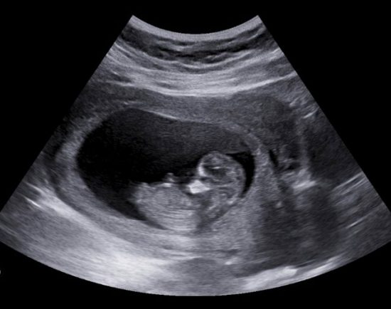 Ultraschallbild Baby 12 Wochen