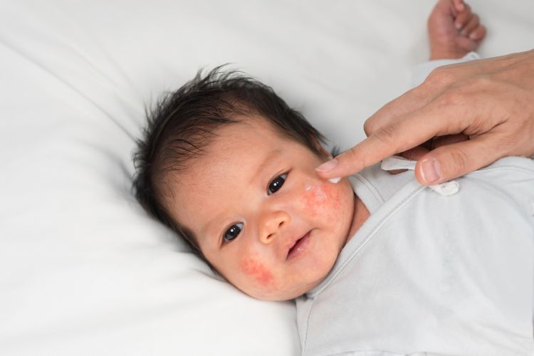 Mutter cremt Gesicht eines Säuglings mit Neurodermitis ein