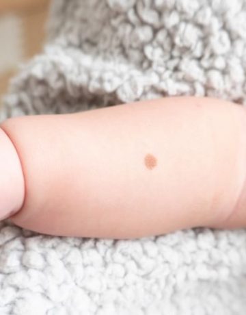 Baby mit Muttermal auf dem Arm