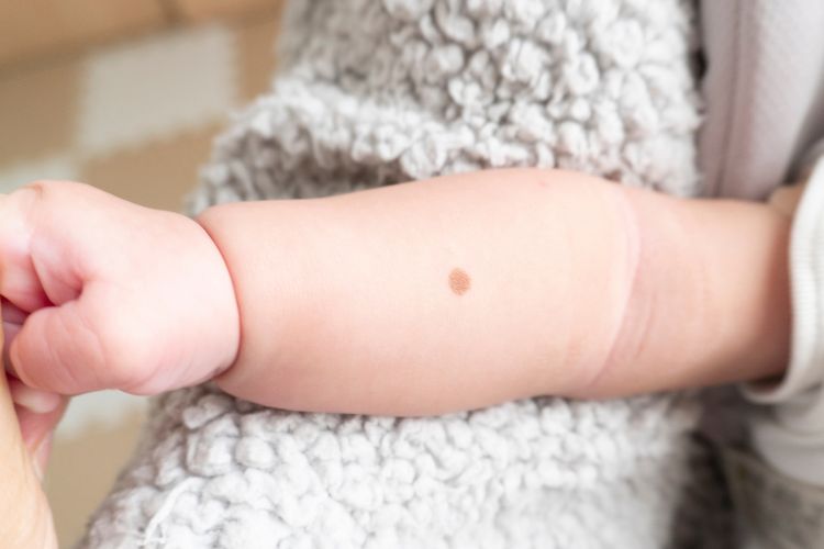 Baby mit Muttermal auf dem Arm