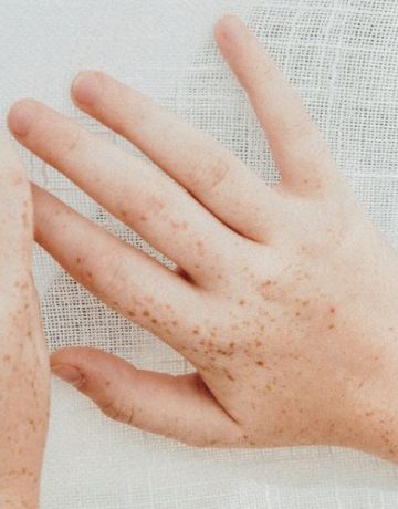 Hautveränderung auf Kinderhand