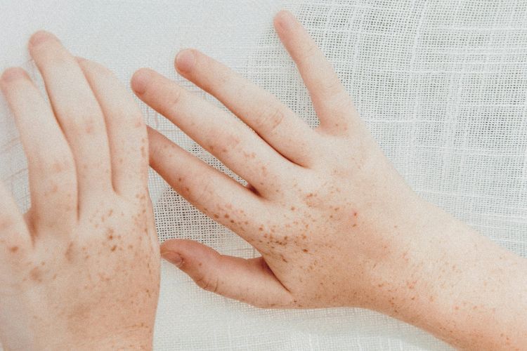 Hautveränderung auf Kinderhand