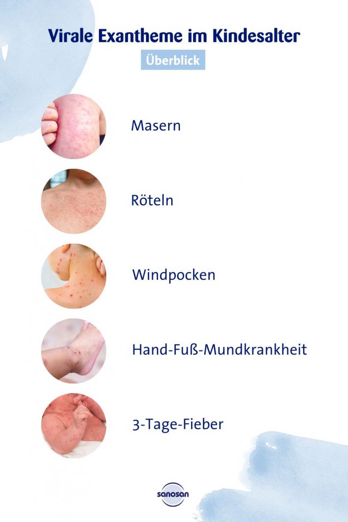 Übersicht über Arten von Exantheme